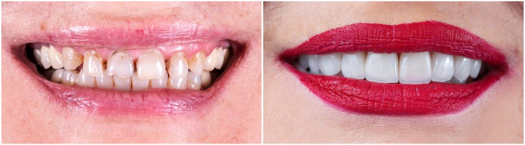 veneers