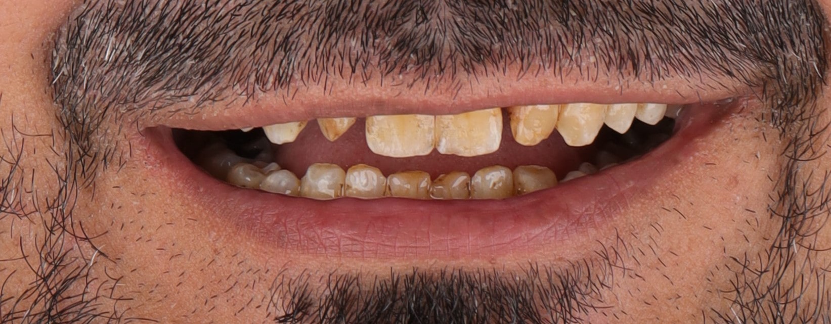 smile transforamtion dental implants were used to restore this smile along with veneers and crowns