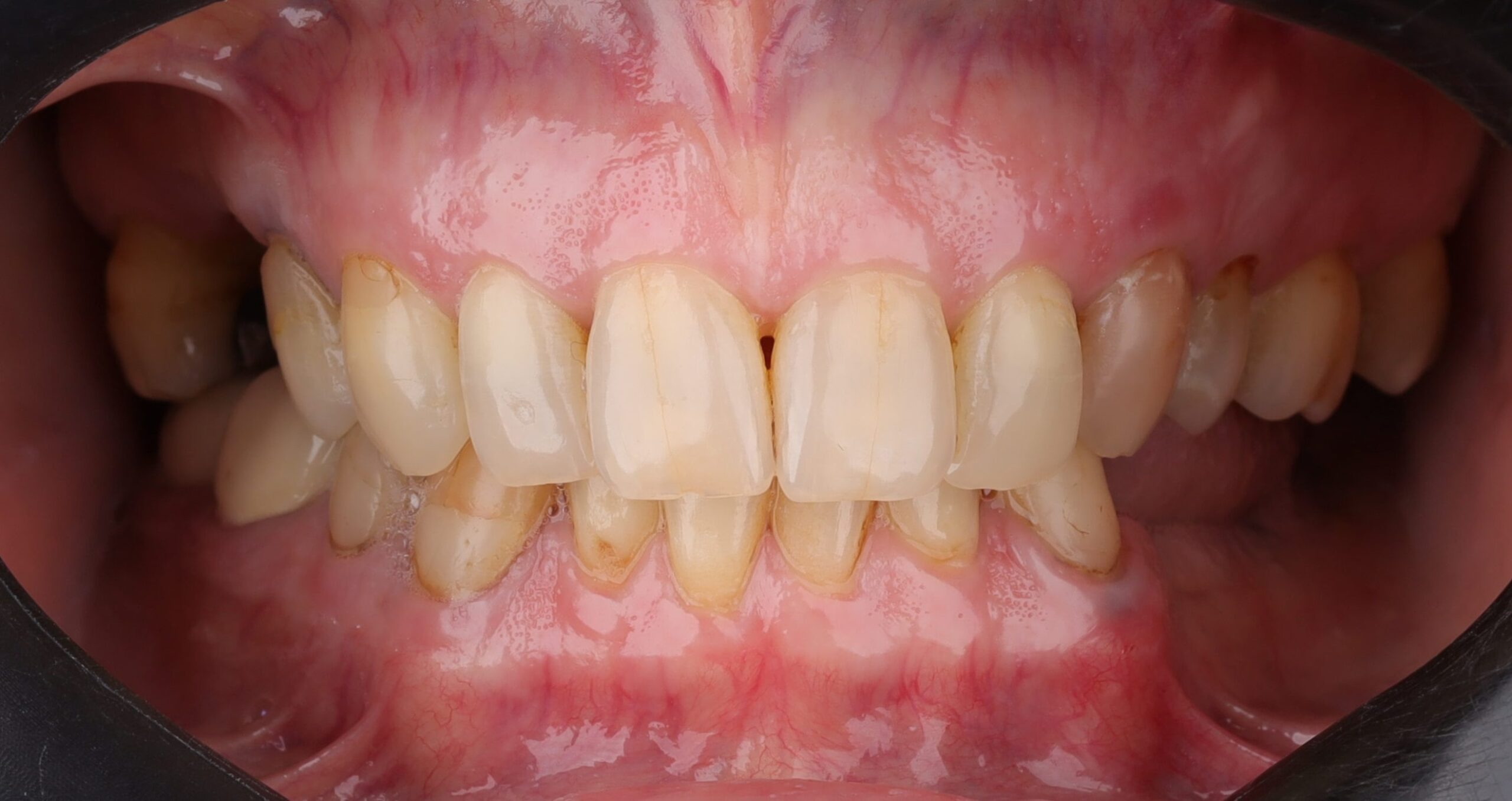 best dental implants in egypt were done at dr eman tantawy dental center dental implants used in this case to restore the free end saddle in the lower jaw