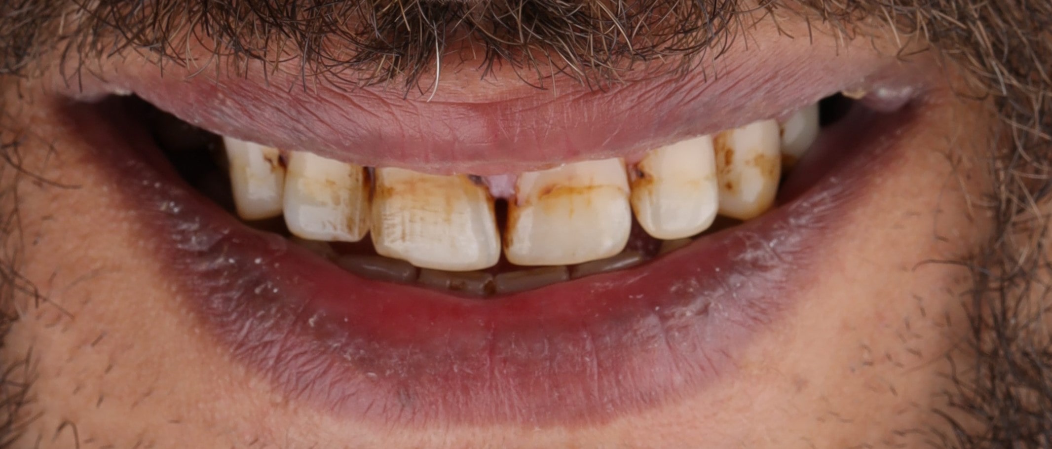 treatment plan for this case was veneers and crowns dental clinic in cairo had a case of tooth discoloration