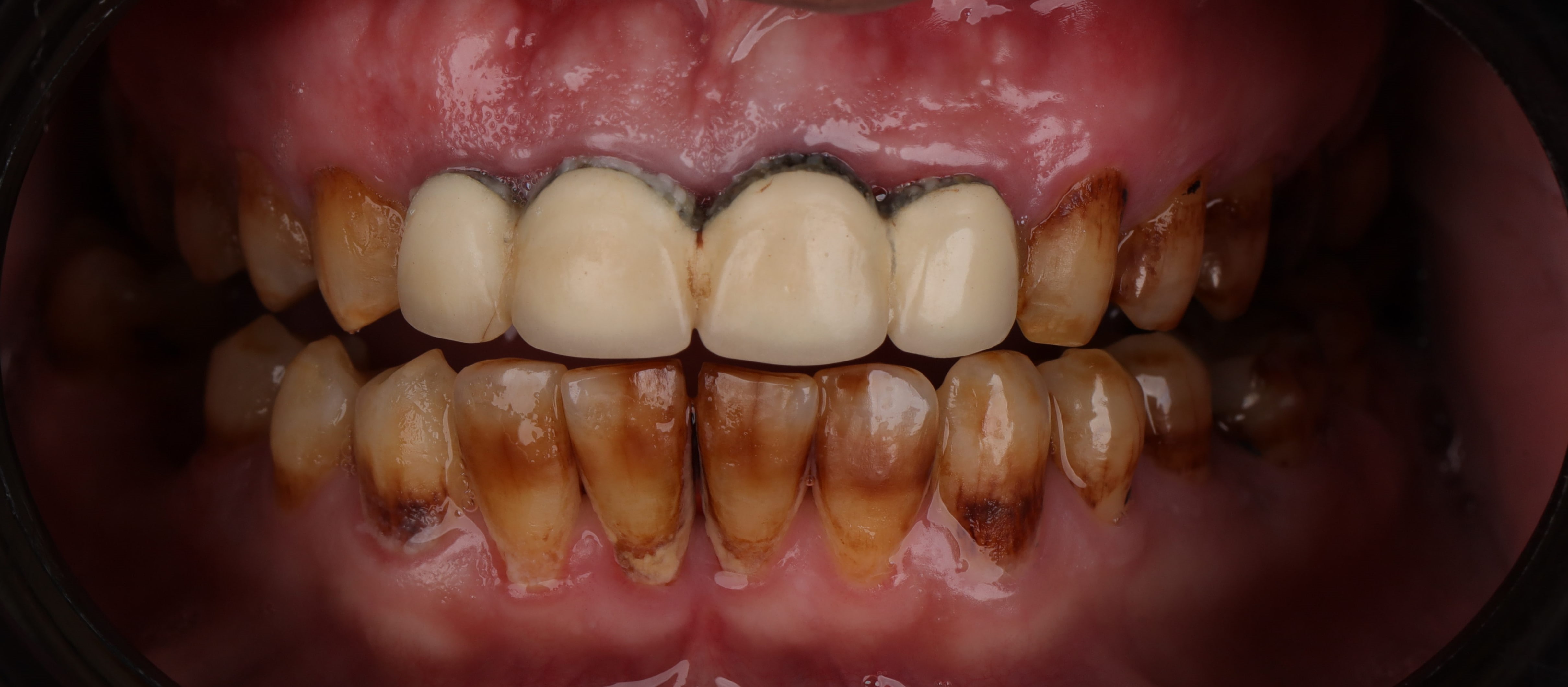 smile enhancement case best dentist old defective restorations treated by top dental clinic in egypt