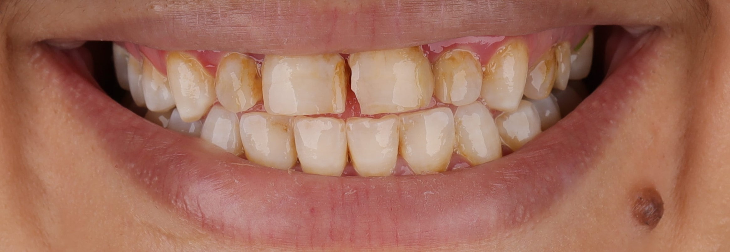 best dentistry in egypt veneers in egypt