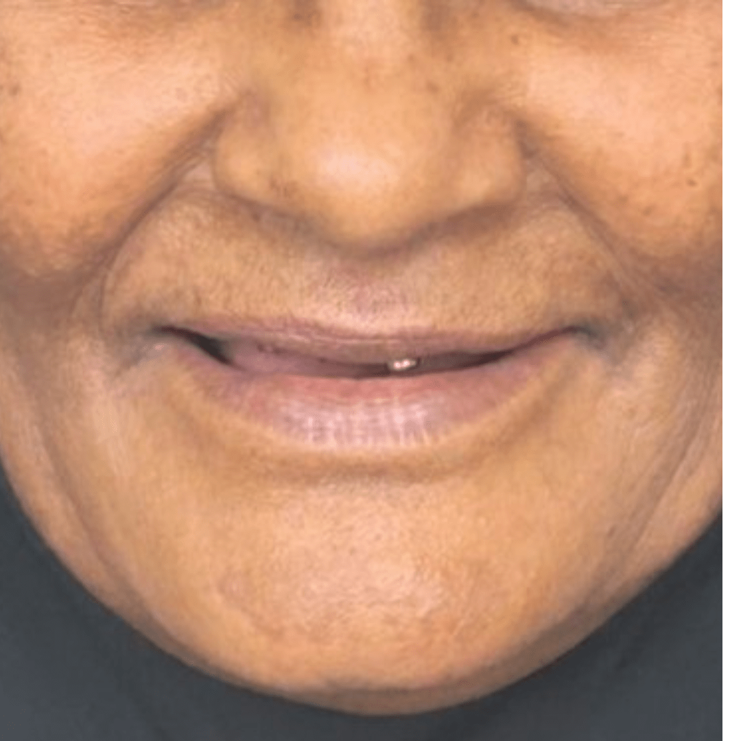 dental implants in egypt patient treated with dental implants