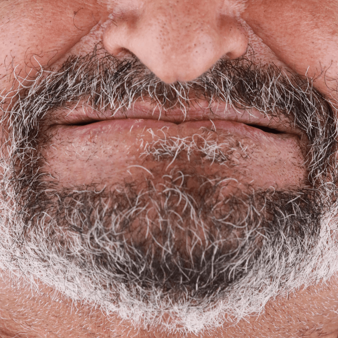 implant supported denture best dental implants in egypt