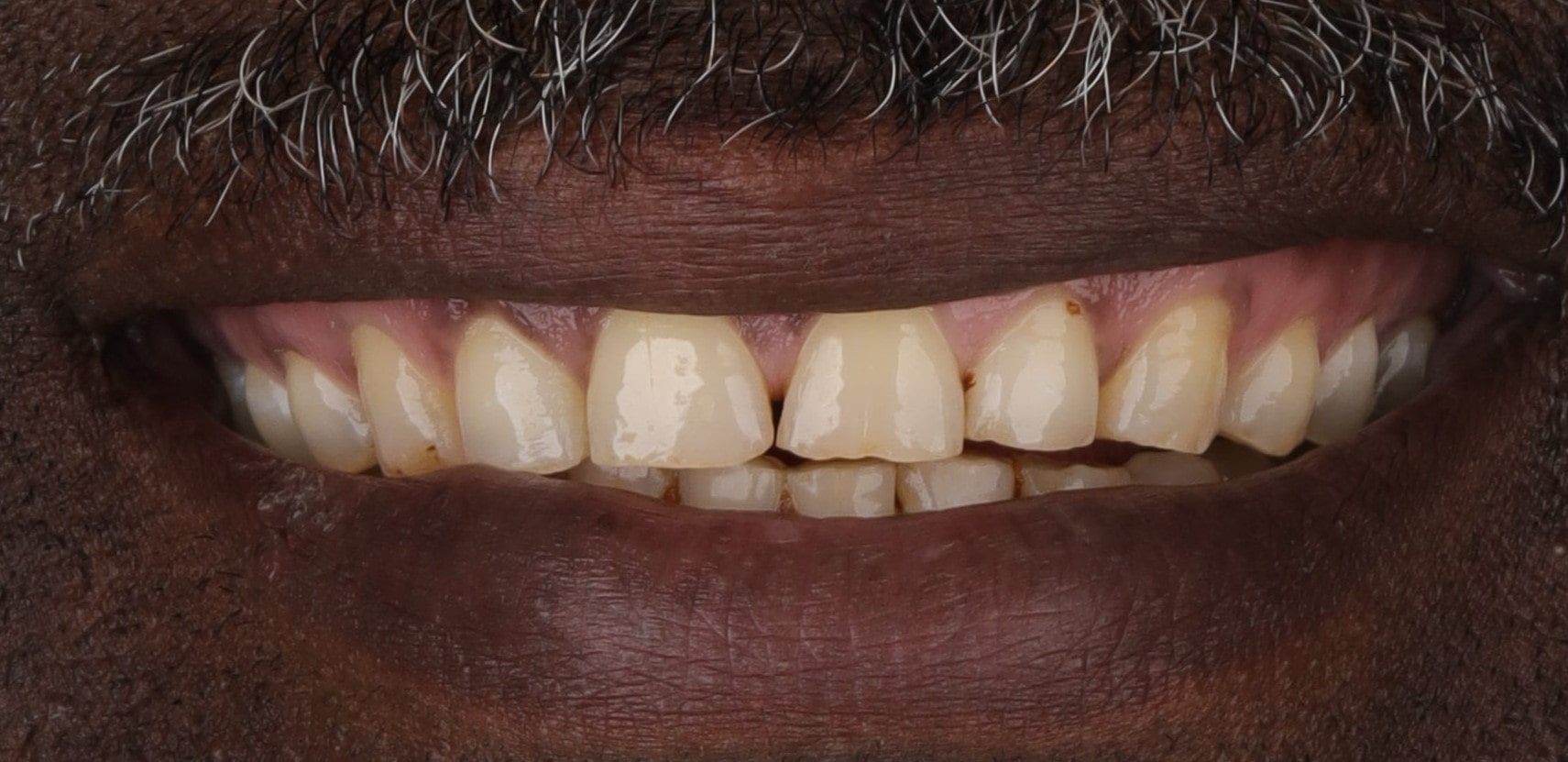 dental veneers transformation best dentist cosmetic dentistry case done by veneers