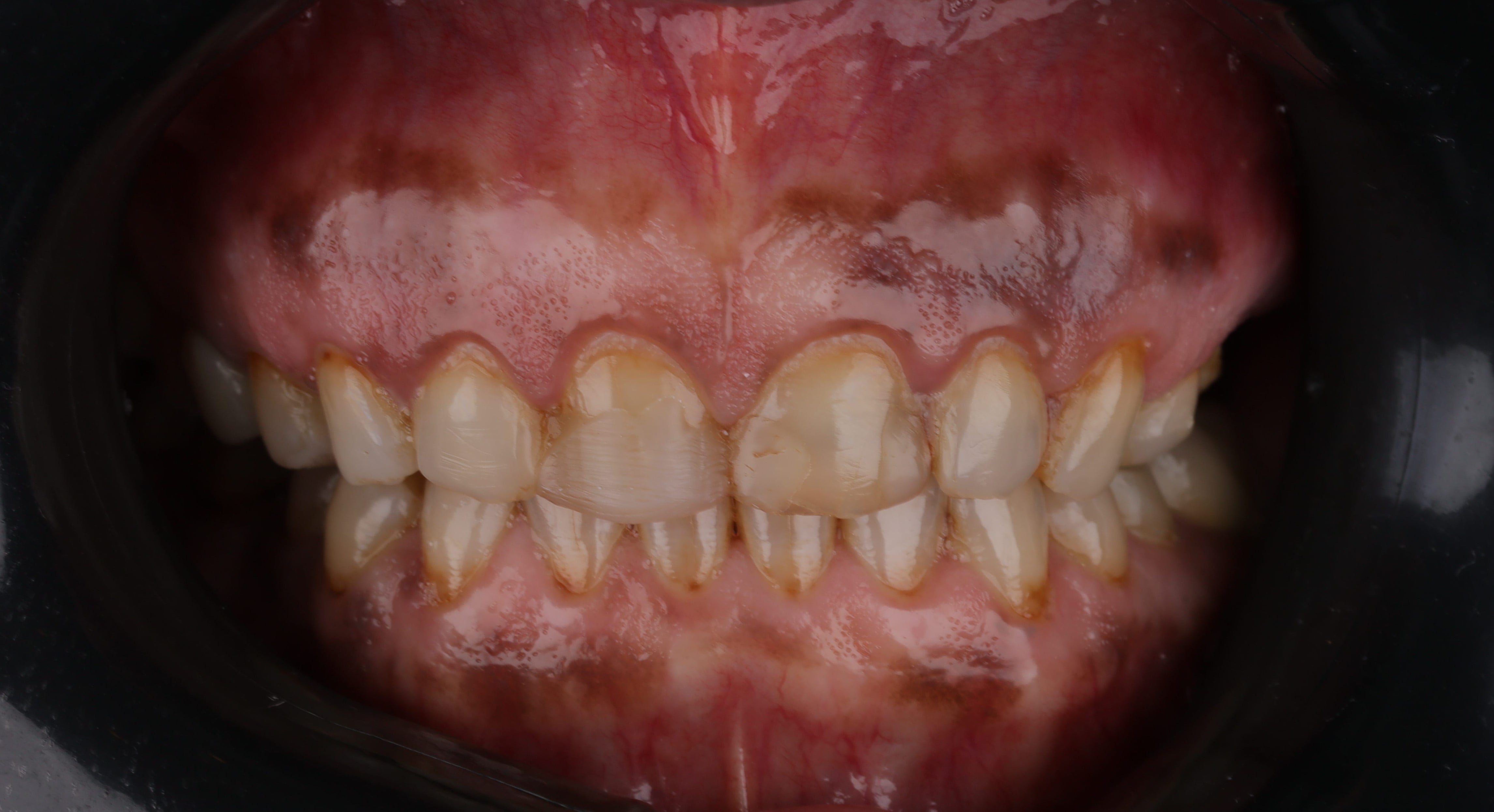 teeth discoloration treated by dental veneers top dentist in egypt treatinf teeth discoloration