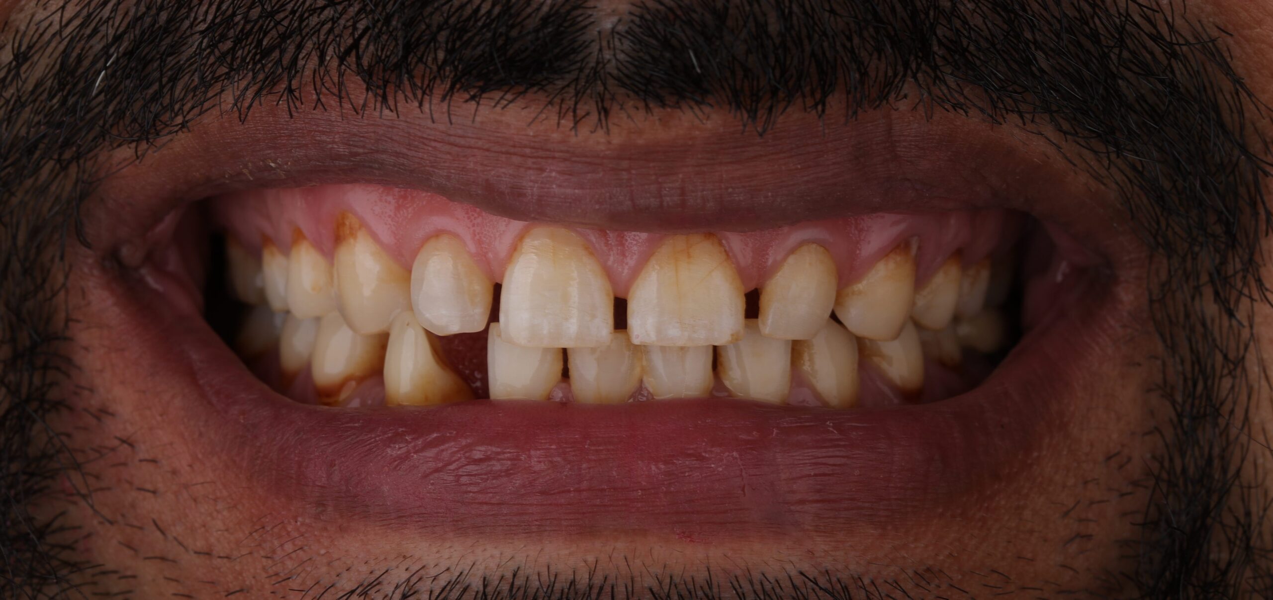 best dental clinic had a case of teeth discoloration best dentist diagnosed case of teeth discoloration and spacing diagnosed in best dental clinic