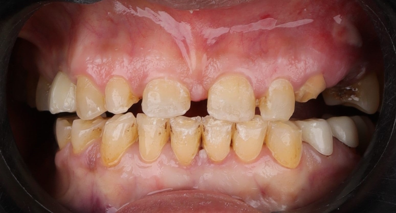 a case of full mouth rehab case treated by veneers and crowns by top cosmetic dentists in egypt